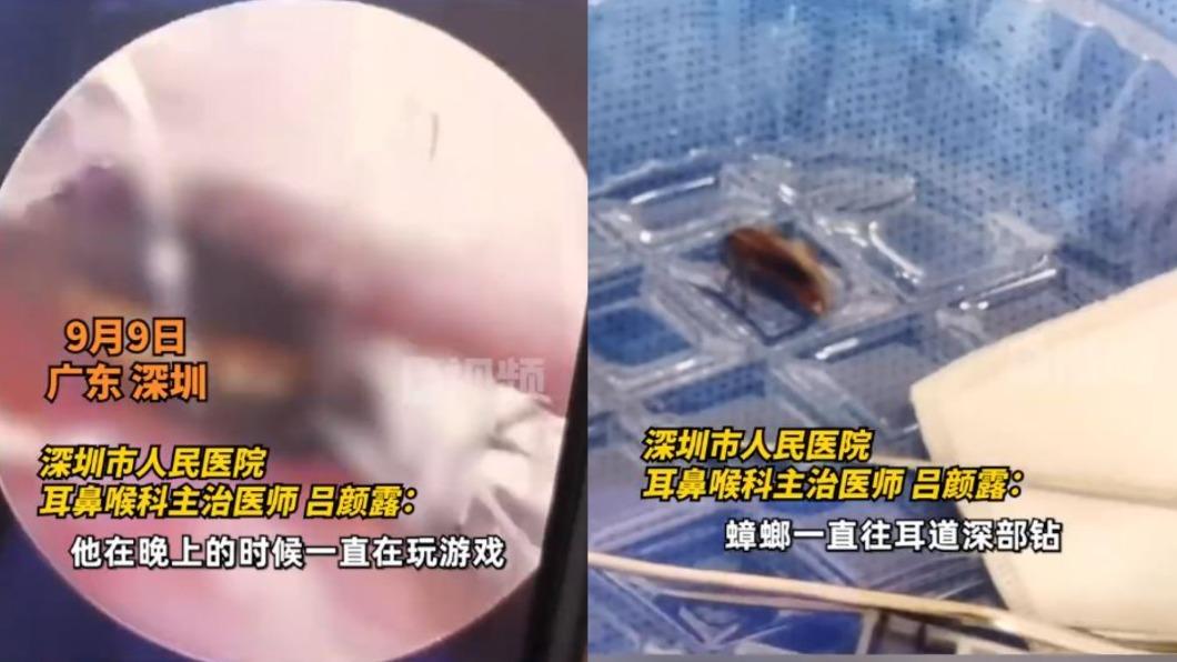 男子衝至醫院求助後,醫師發現蟑螂竟緊抓他的耳膜不放。(圖/翻攝自微博)