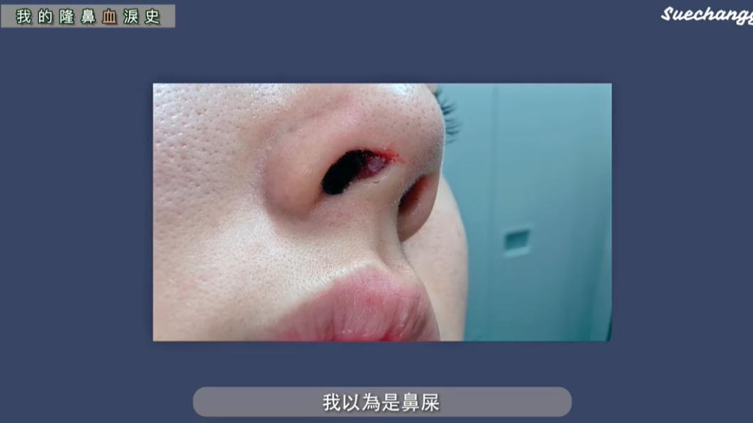 二次隆鼻後,假體穿出鼻子外。(圖/翻攝自suechangg YT頻道)