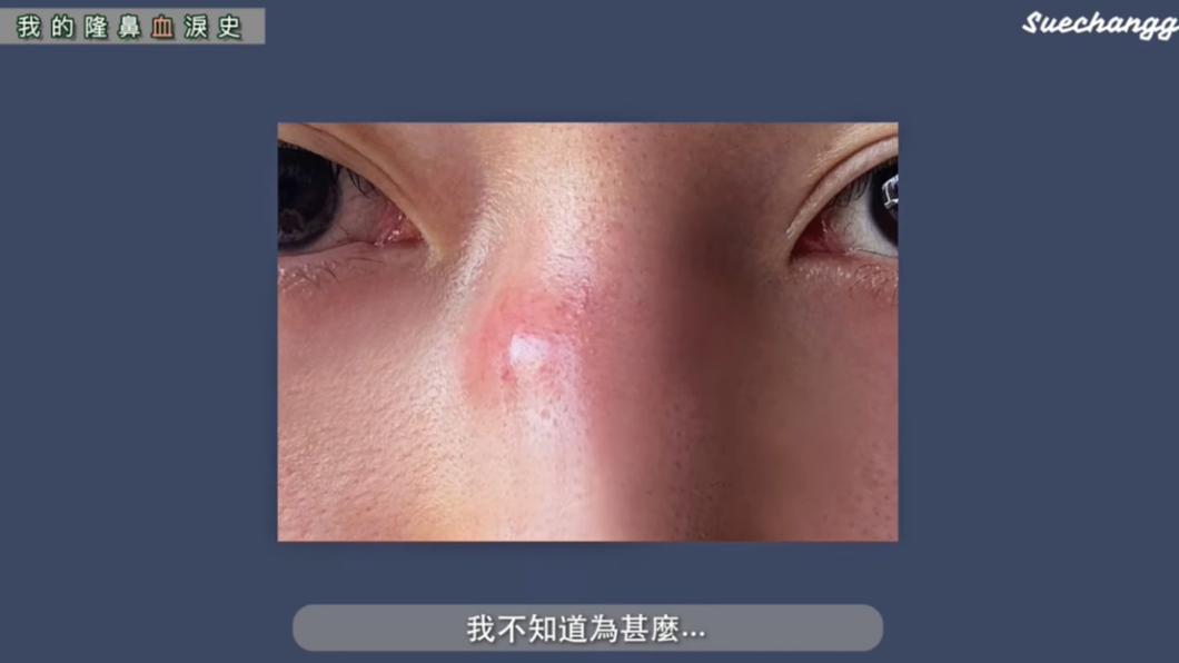 Sue在第一次手術狂冒水泡。(圖/翻攝自suechangg YT頻道)