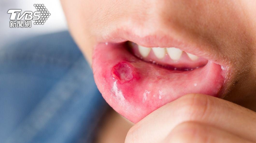 一名男子經常嘴破導致細菌攻擊心臟，造成二尖瓣破洞。（示意圖／shutterstock達志影像）