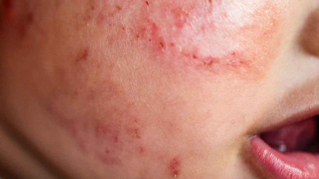 家人偷親一口!女嬰慘「病毒竄全身」冒紫疹 浮腫變形險丟命