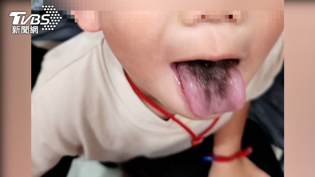 家長嚇壞!4歲兒長「黑毛舌苔」 就醫查出竟是因「抗生素」