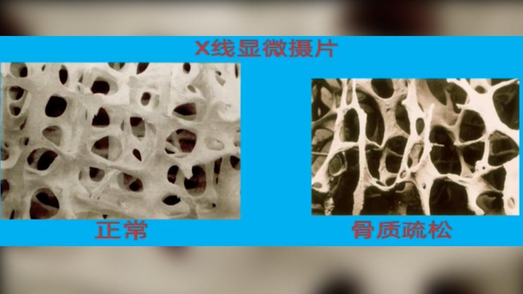 醫生表示,女子罹患骨質疏鬆症。(圖/翻攝自微博《九派新聞》)
