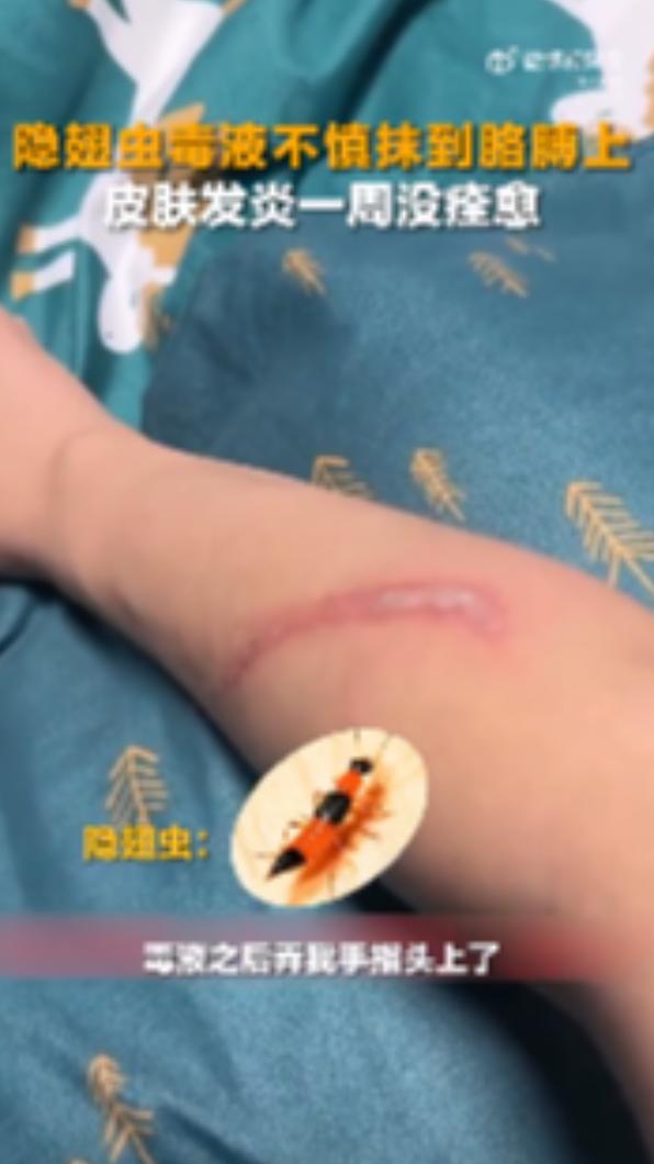 女子手臂沾到隱翅蟲毒液,傷口一週還沒好。(圖/翻攝自微博)
