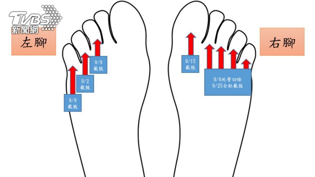 8根腳趾截肢。(圖/TVBS)