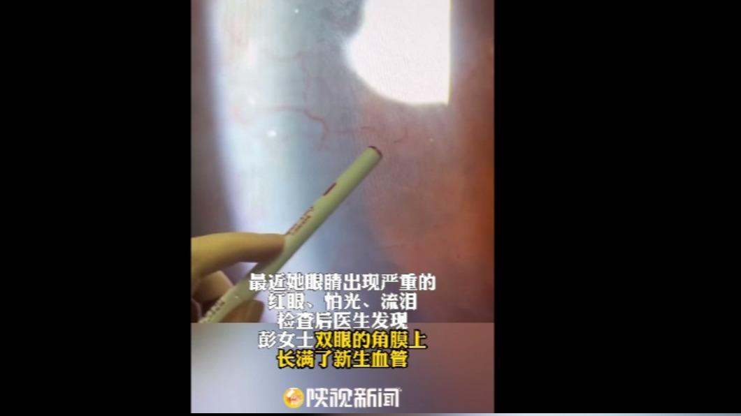 該名女子隱眼不離身,每天竟戴超過12小時直到睡前才拿下。(圖/翻攝自微博 @陝視新聞)