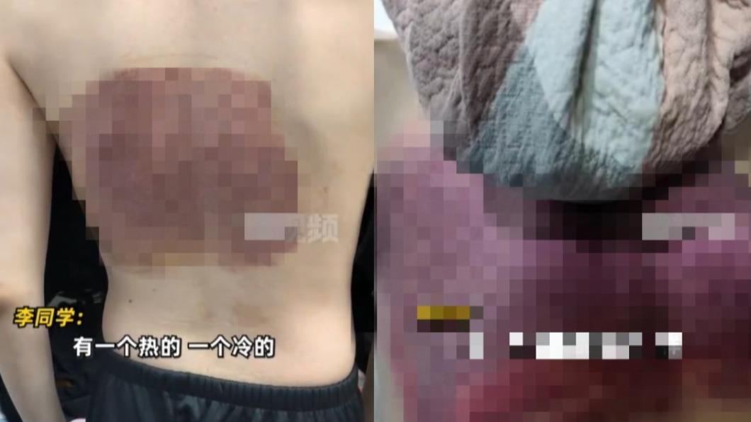 遭排水孔吸住險缺氧!滿背瘀青如虐打 業者淡定:當免費拔罐