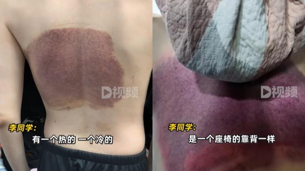 業者一度回應「當免費拔罐就好」。(圖/翻攝自@大河報 微博)