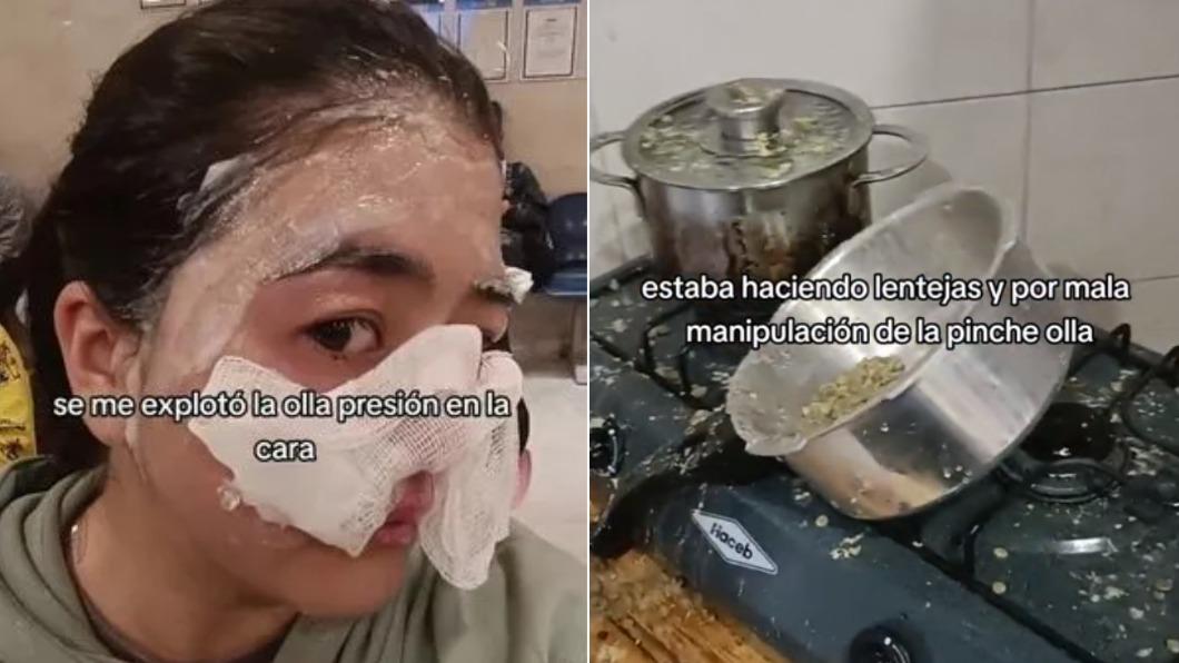 關火下一秒「滾燙食物炸出」 女子用高壓鍋煮飯險毀容