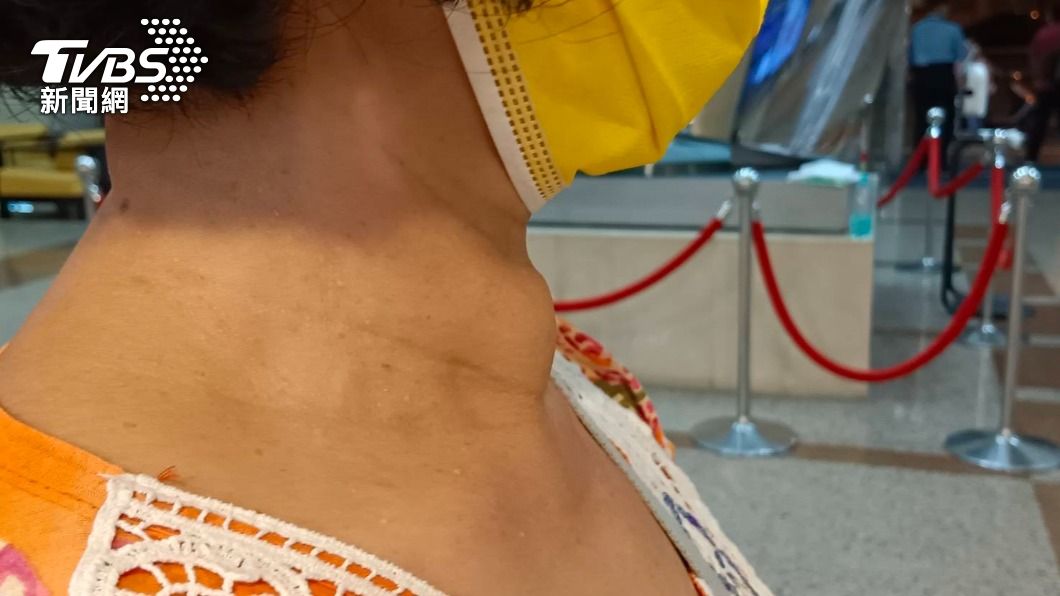 半年減重10公斤!婦脖子腫一大圈 醫:有5症狀快檢查
