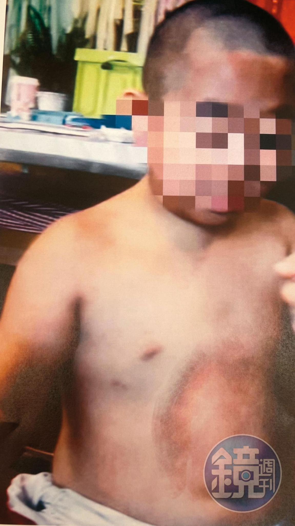 7歲男童小達（化名）遭快艇撞擊，頭、胸、腹部紅腫瘀傷。（圖／鏡週刊）