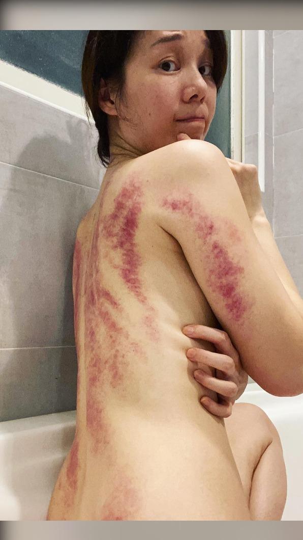 許乃涵分享全裸蹲做浴缸辣照,但背上刮痧令人觸目驚心。(圖/翻攝自臉書)