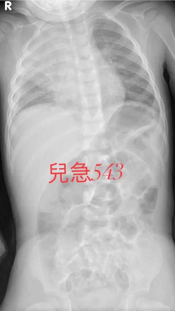 吳昌騰PO出肺炎病患X光圖。（圖／翻攝自胡瓜臉書）