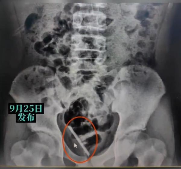 體溫計進入膀胱中。(圖/翻攝自微博)