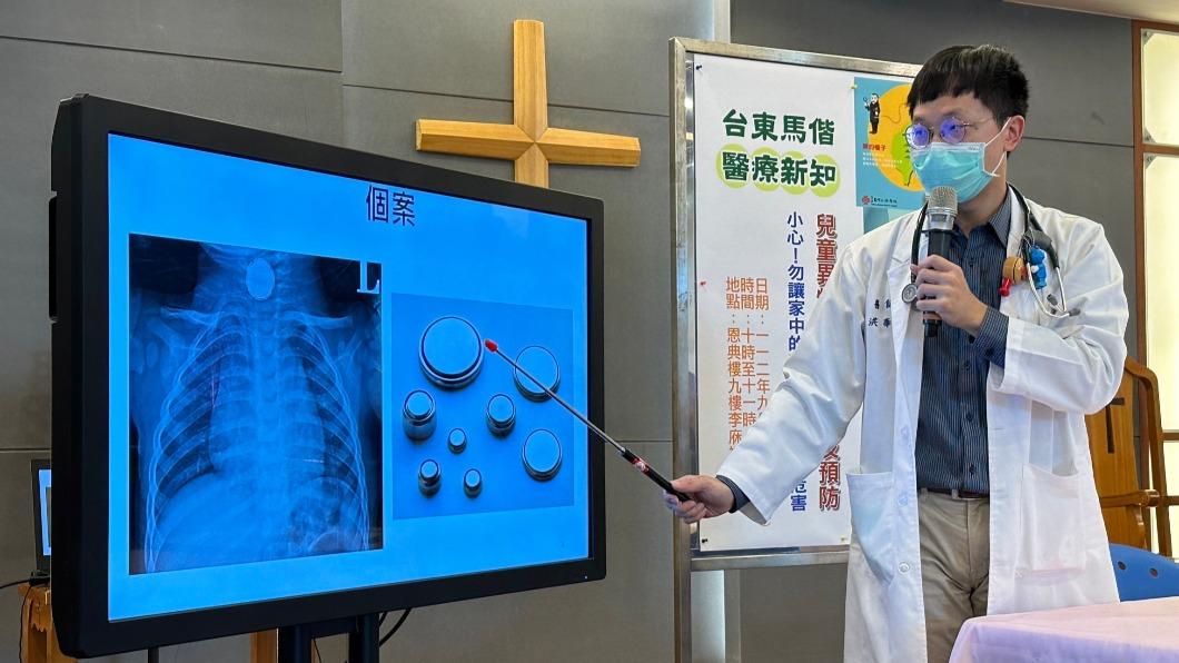 家長注意!台東一歲半幼童誤食鈕扣電池 食道腐蝕穿孔