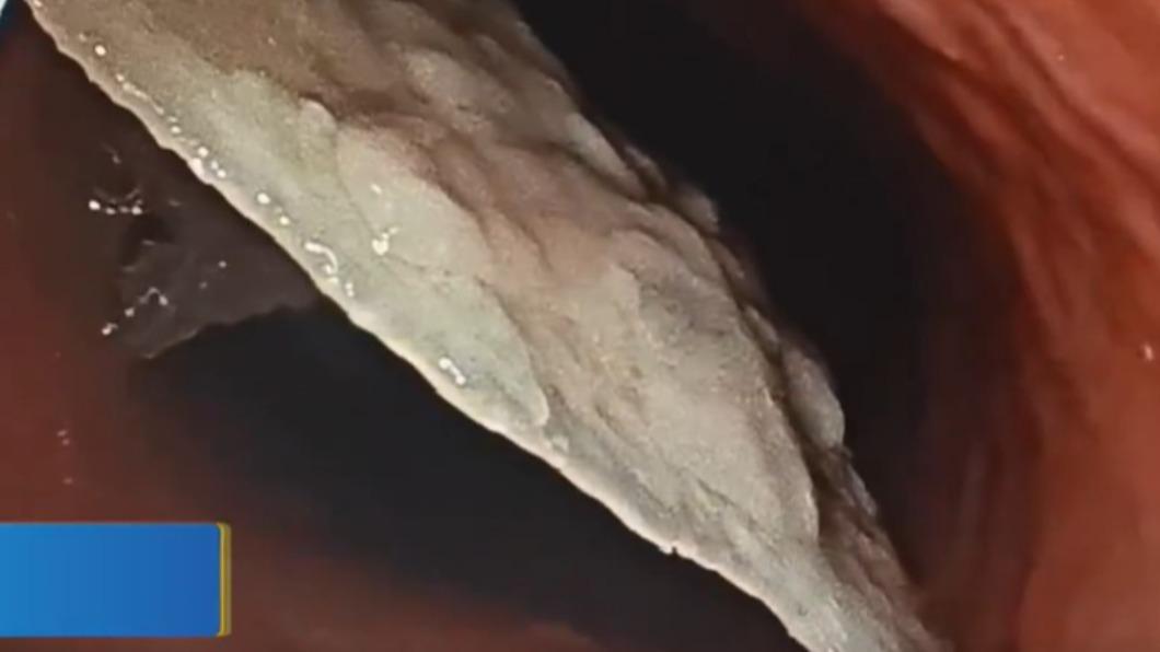 喝粥一口吞頸部痛爆!醫一照她嚇傻 「整片排骨」刺破食道