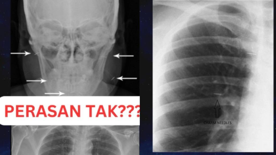 該名女病患身上插滿了魅力針，直到死前仍不願拔除。（圖／翻攝自 TikTok＠pakar.mata）