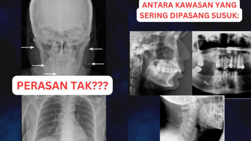 拉茲夫表示,經過X光檢查,可看到病患體內插入了不少魅力針。(圖/翻攝自pakar.mata TikTok)