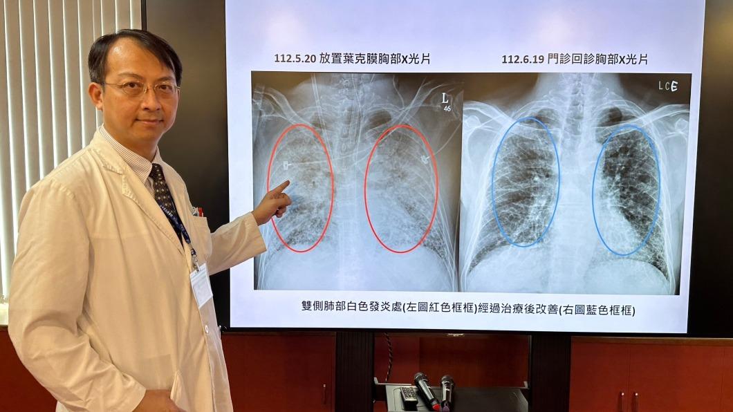 64歲男子流感合併呼吸窘迫轉重症 葉克膜搶救17天