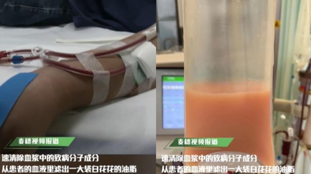 醫生從男子的血液裡過濾出一大袋油脂。（圖／翻攝自微博《麥穗視頻》）