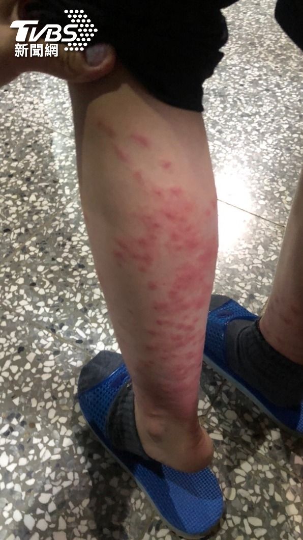 陳綢兒少家園內職員與孩子們被小黑蚊「吻」過的腳,出現可怕的紅腫與過敏現象