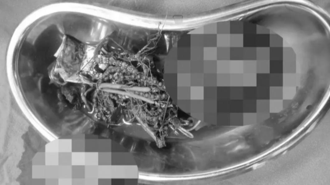 男子緊急接受手術,取出異物。(圖/翻攝自紐約郵報)