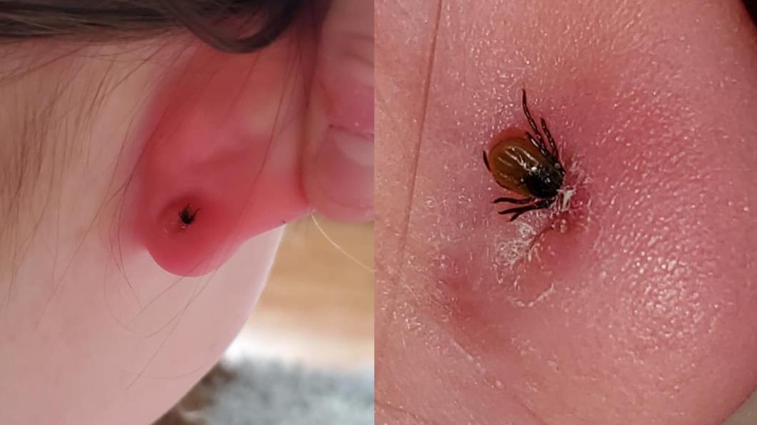 女兒耳朵腫痛以為長痘 細看竟是「吸血蟲」躲耳環作怪
