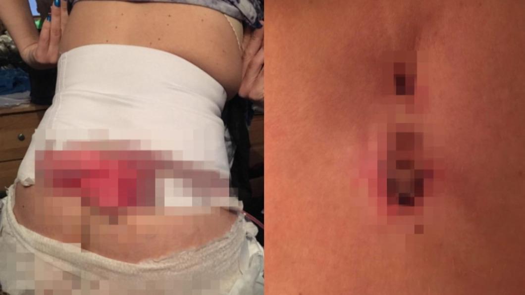 隆乳生爛瘡「能伸手抓脊椎」!腐臭味狂飄 2寶媽慘成畸形胸