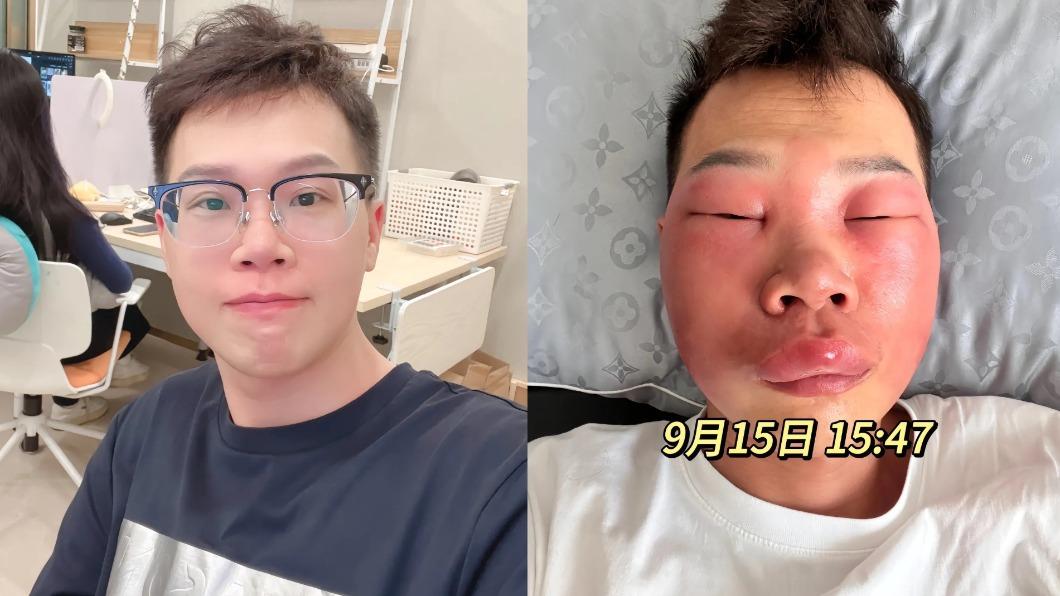 太愛挖鼻孔!33歲男「臉腫7天變豬頭」 對比圖瘋傳全場嚇壞