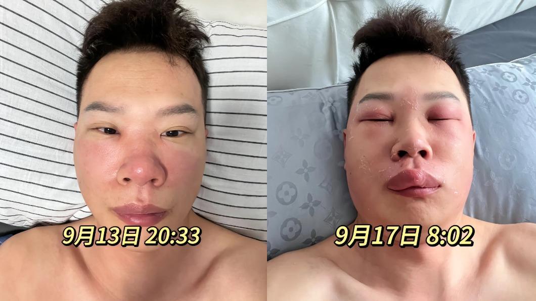 男子病情惡化，臉部越來越腫。（圖／翻攝自微博《梨子視頻》）