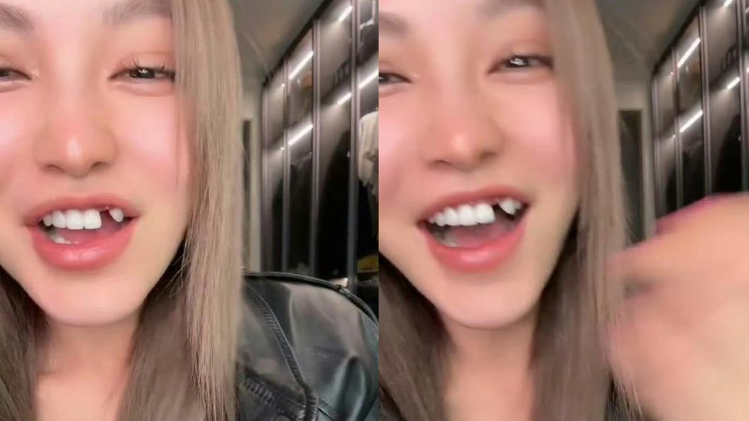 周揚青牙齒意外掉了。(圖/翻攝自周揚青微博)