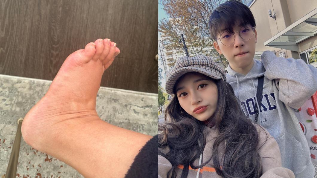 祈錦鈅和老公在溫哥華展開全新生活,不過她深受水腫所擾,讓她直呼很痛苦。(圖/翻攝自祈錦鈅臉書)