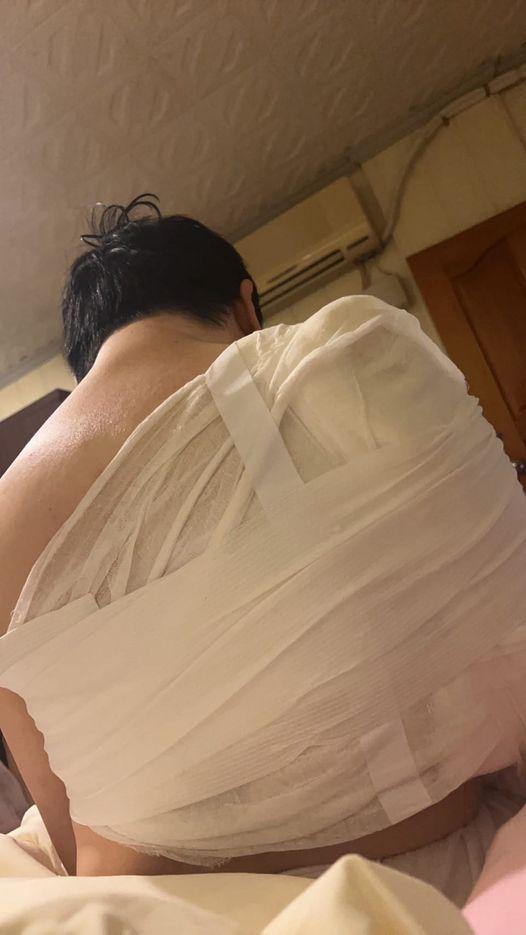 蔡義德只能用石膏治療。（圖／翻攝自蔡義德親友臉書）