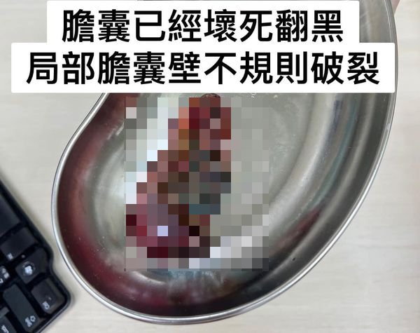 該名男子的膽竟腫得像香腸般肥大。(圖/翻攝自 胰臟醫師林相宏禾馨民權內科診所臉書粉專)