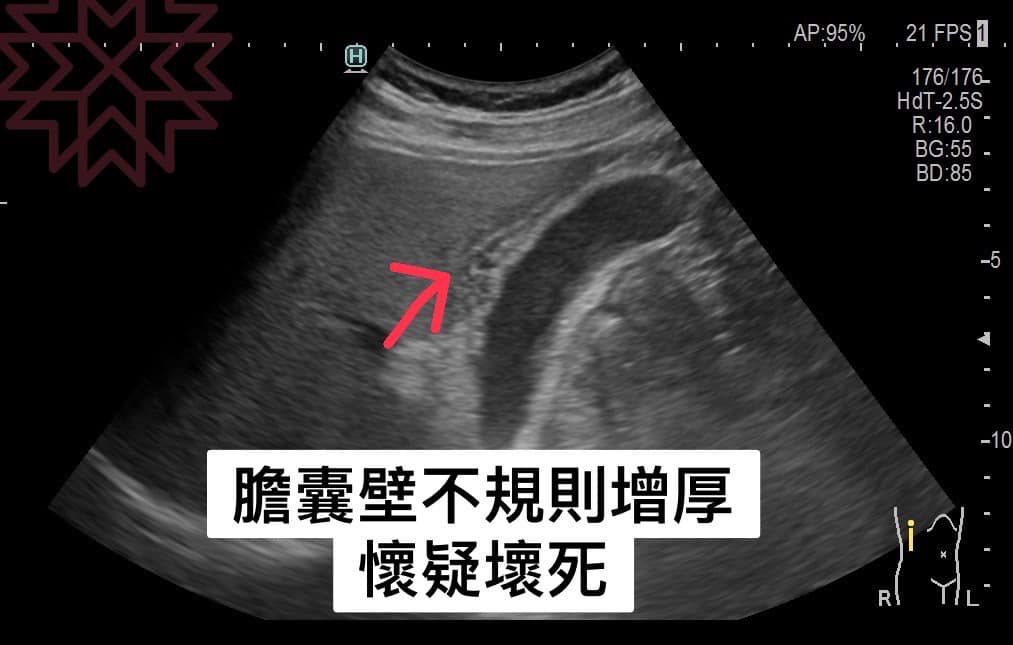 該名男子的膽囊壁不規則增厚疑似壞死。(圖/翻攝自 胰臟醫師林相宏禾馨民權內科診所臉書粉專)