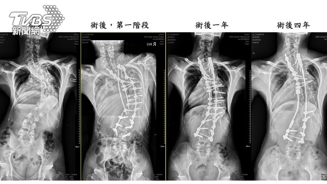 「龜背少年」番玉磊成功手術後每年定期追蹤,均維持良好狀態。(照片中醫大附醫提供)