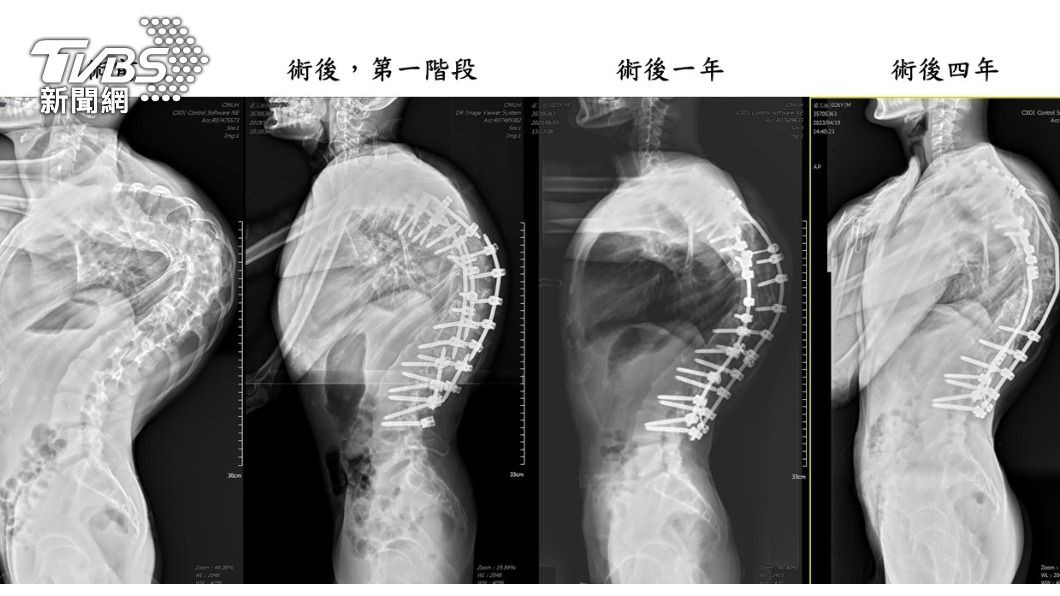 「龜背少年」番玉磊成功手術後每年定期追蹤,均維持良好狀態。(照片中醫大附醫提供)