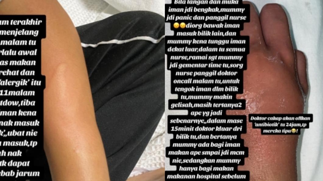 男童手臂出現腫脹與紫色反應。(圖/翻攝自 TikTok@suzieyanashariff)