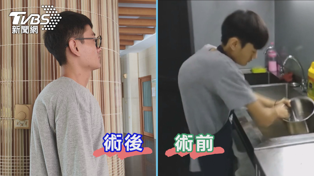 緬甸「龜背少年」來台求醫 矯正脊椎側彎長高12公分