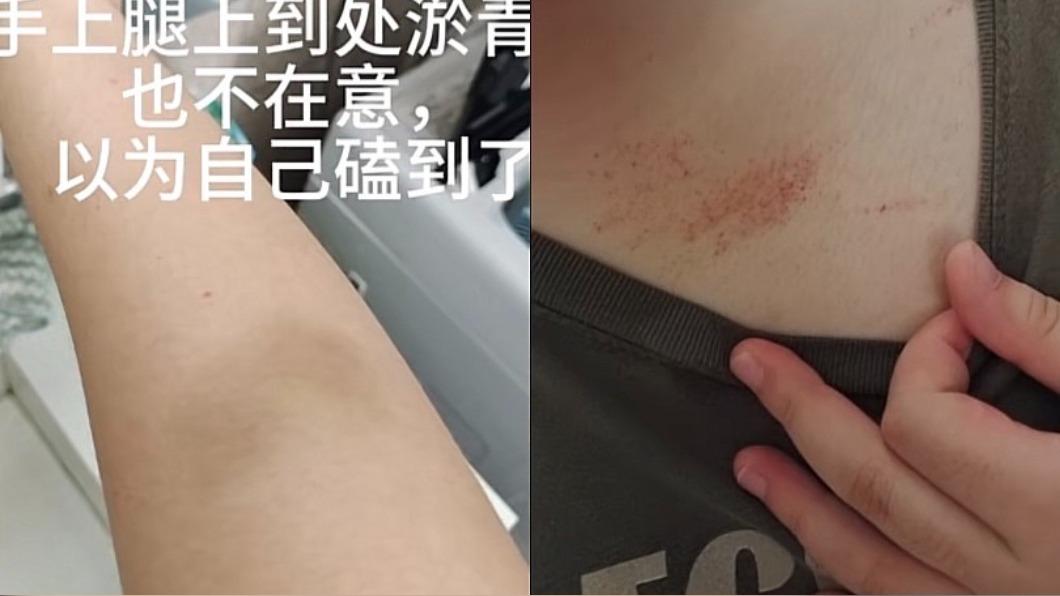 身上冒不明紅點淤青!妹子堅持旅遊 一就醫竟收「病危通知」