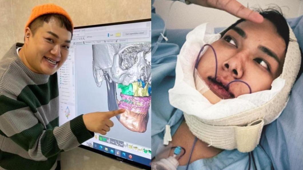 關關在正顎手術後臉部嚴重腫漲,就連進食都有些困難。(圖/翻攝自關韶文IG)