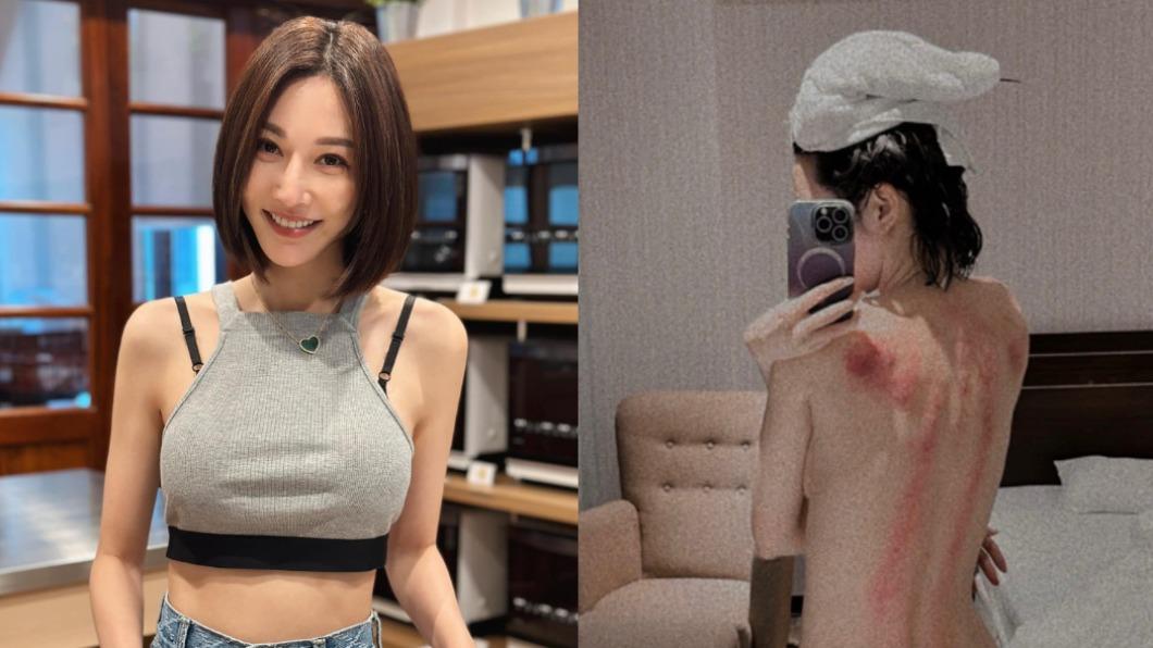 曾莞婷前陣子在社群分享刮痧照,背上紅痕滿布,看來身體相當疲累。(圖/翻攝自曾莞婷臉書)