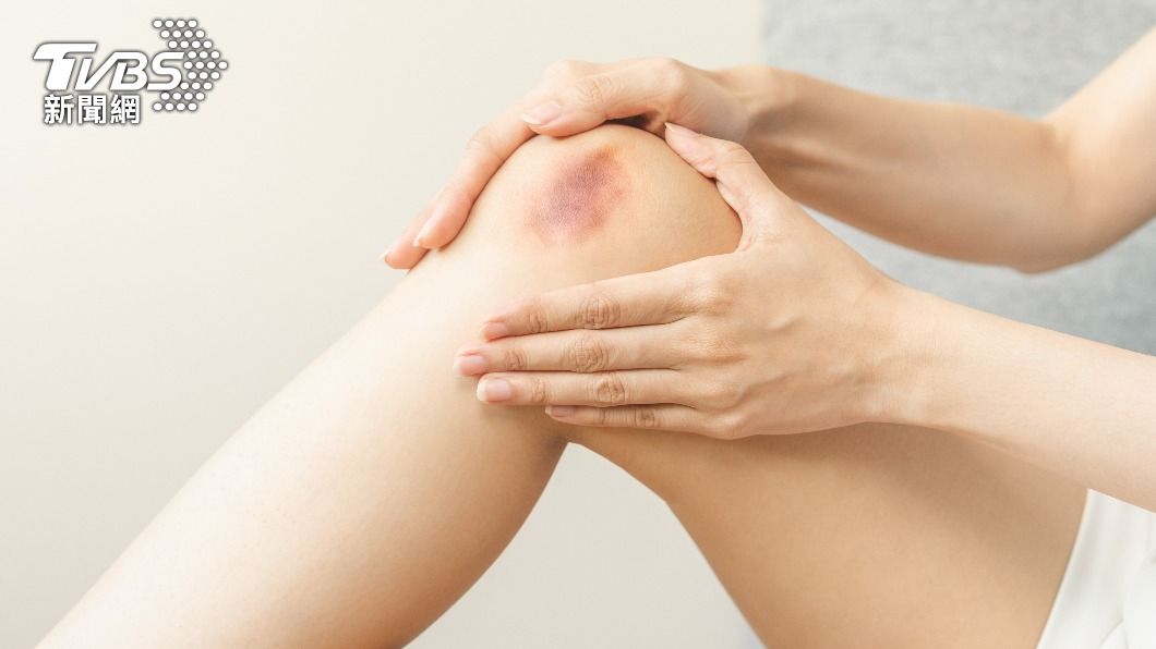 常常瘀青是肝病警訊。（示意圖，非當事人／shutterstock達志影像）