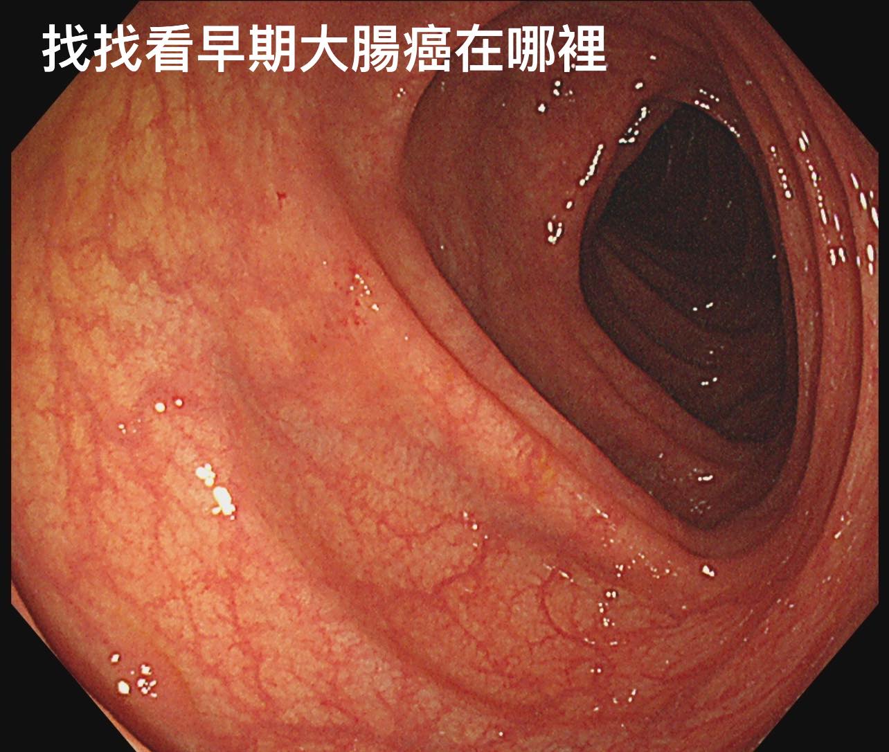 大腸鏡照出「不到1公分瘜肉」 醫驚:漏掉一定是嚴重大腸癌