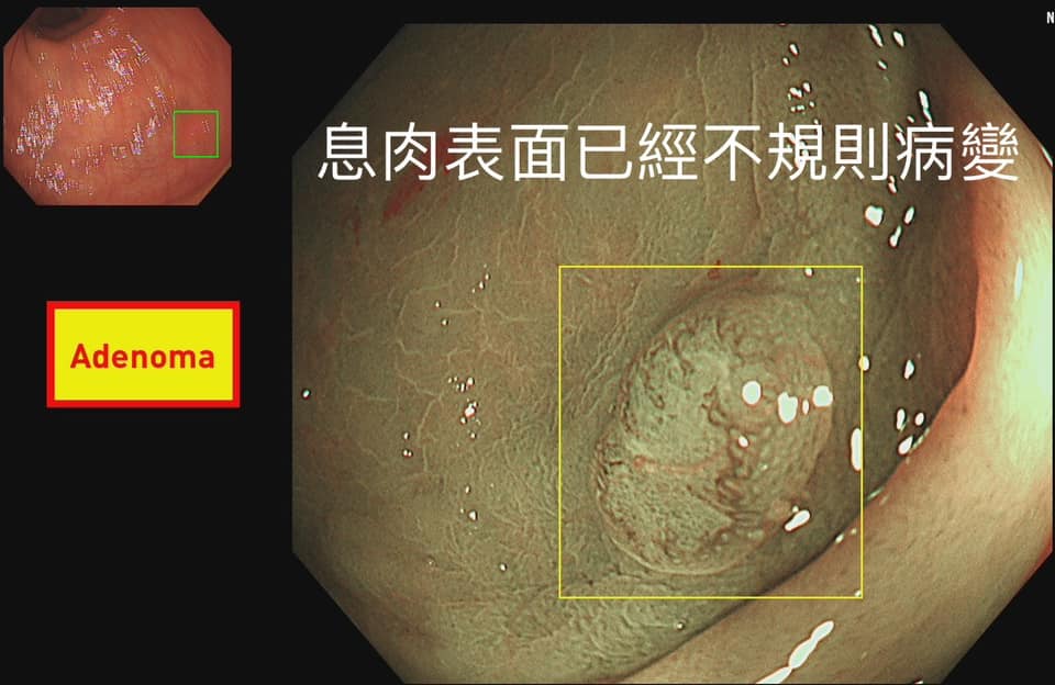 息肉表面絨毛已經呈現不規則病變，切除後化驗居然是「0期大腸癌」。（圖／翻攝胰臟醫師 林相宏 禾馨民權內科診所 臉書）