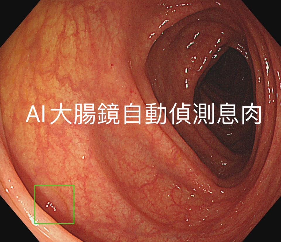 小息肉只有不到1公分，而且位在大腸的褶皺處。（圖／翻攝胰臟醫師 林相宏 禾馨民權內科診所 臉書）