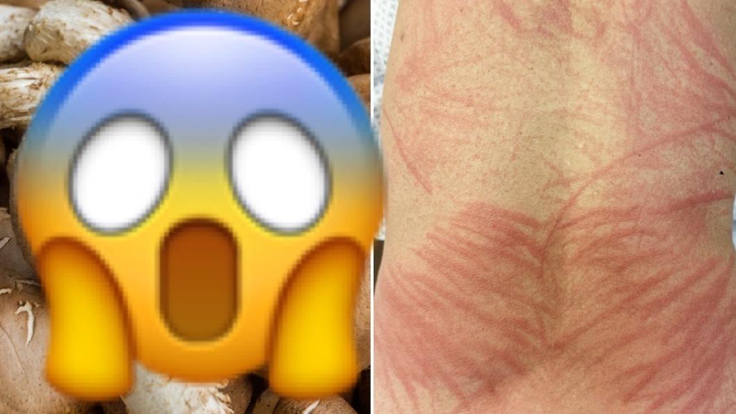當心!「這常見食材」沒煮熟 皮膚起大片紅疹:像被打過