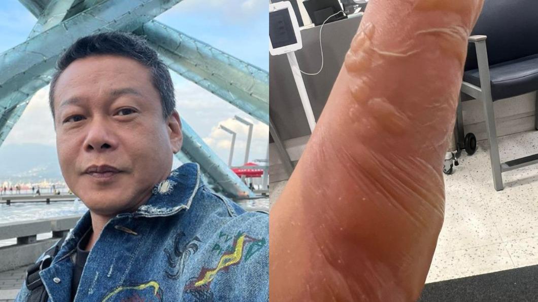 金馬影帝出事!手臂遭滾水燙「起泡潰爛」 急診室等8小時氣炸