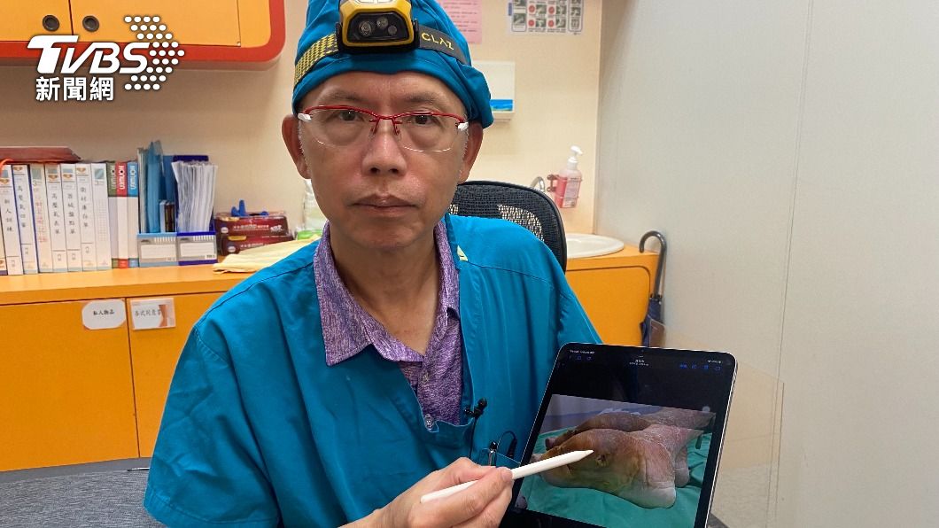 糖尿病患者腳底傷口爛到小腿 腫到「麵龜」差點截肢