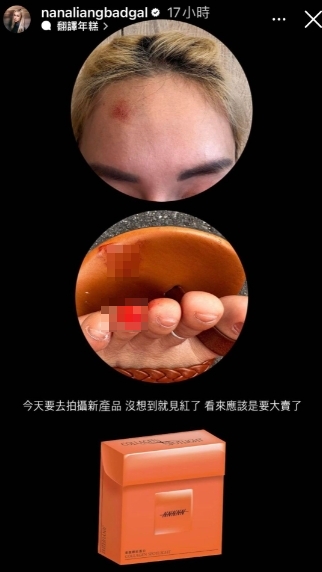 梁云菲額頭紅腫和腳趾流血。(圖/翻攝梁云菲IG)